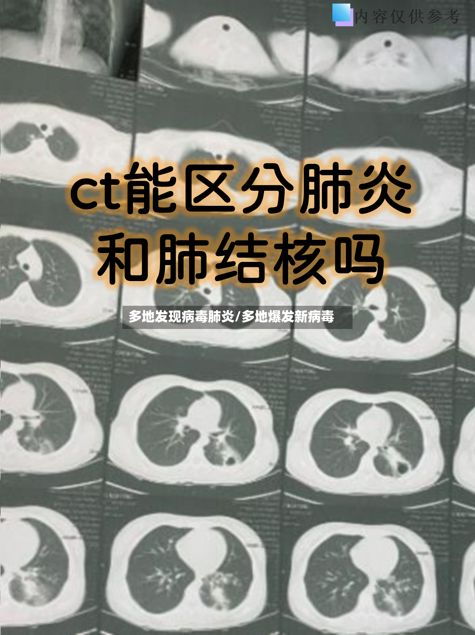 多地发现病毒肺炎/多地爆发新病毒