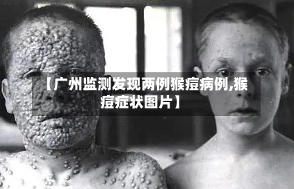 【广州监测发现两例猴痘病例,猴痘症状图片】-第2张图片