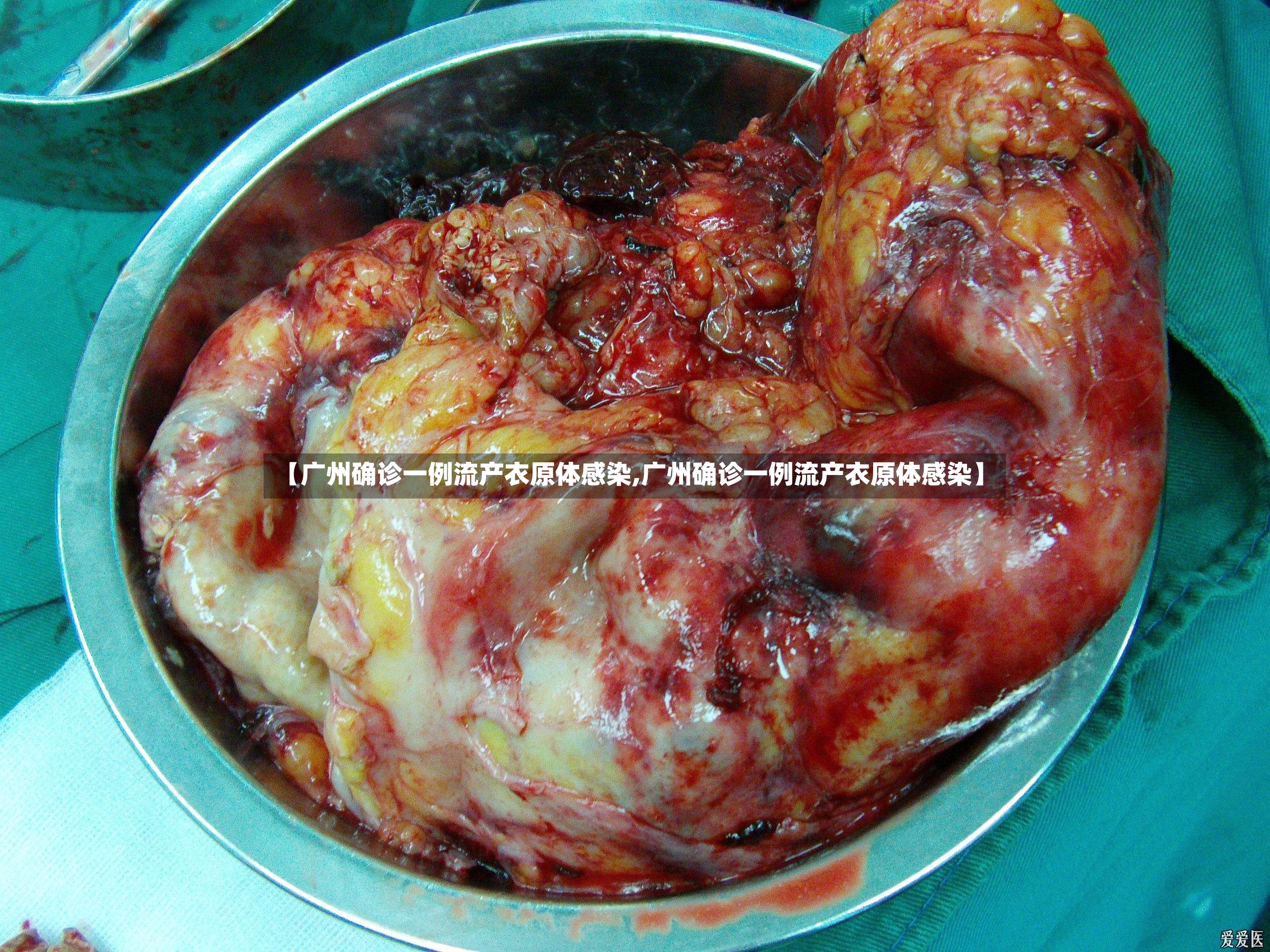 【广州确诊一例流产衣原体感染,广州确诊一例流产衣原体感染】-第2张图片