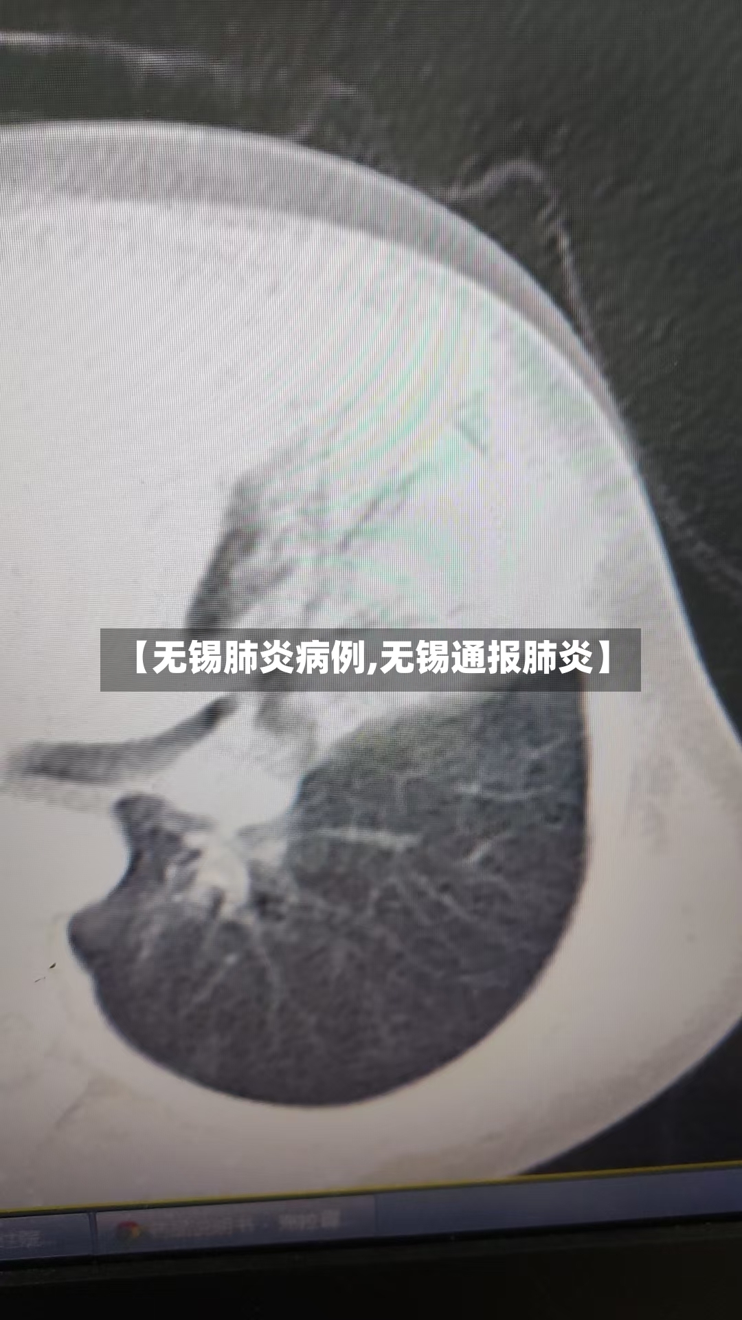 【无锡肺炎病例,无锡通报肺炎】